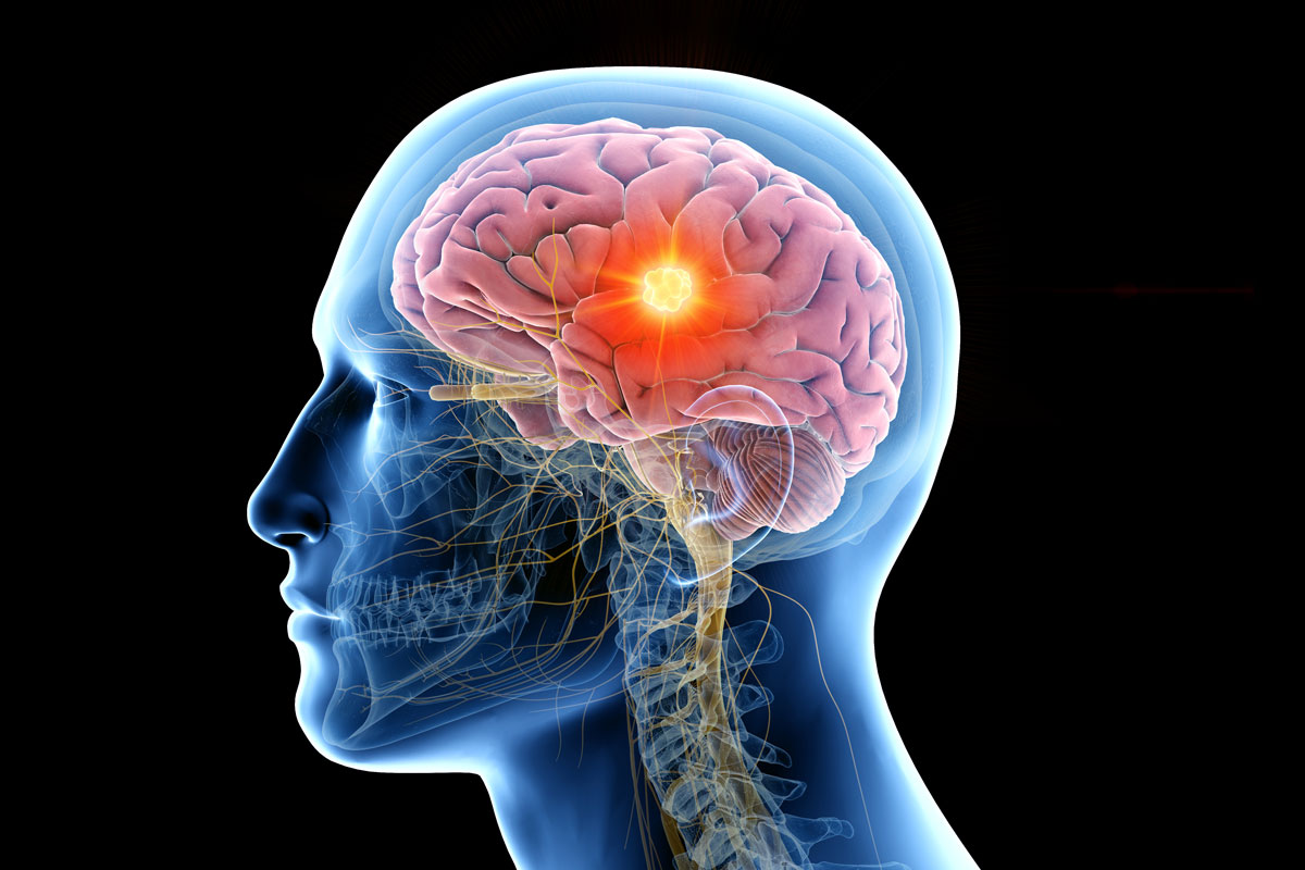 brain tumor therapy