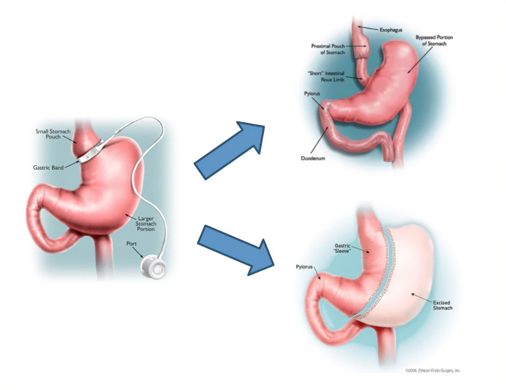 Revision and Conversion Procedure graphic